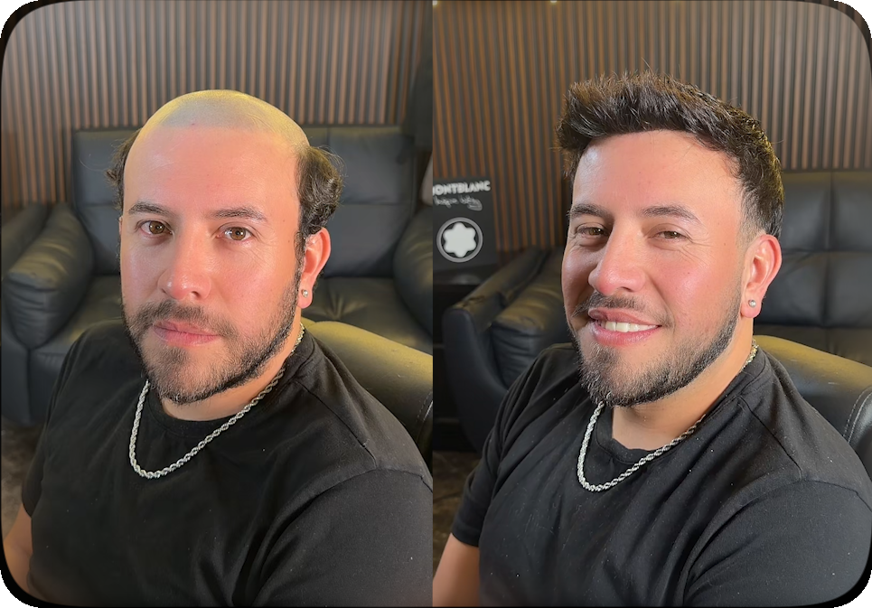 Antes y después de Iván, de frente, con un diseño capilar a medida